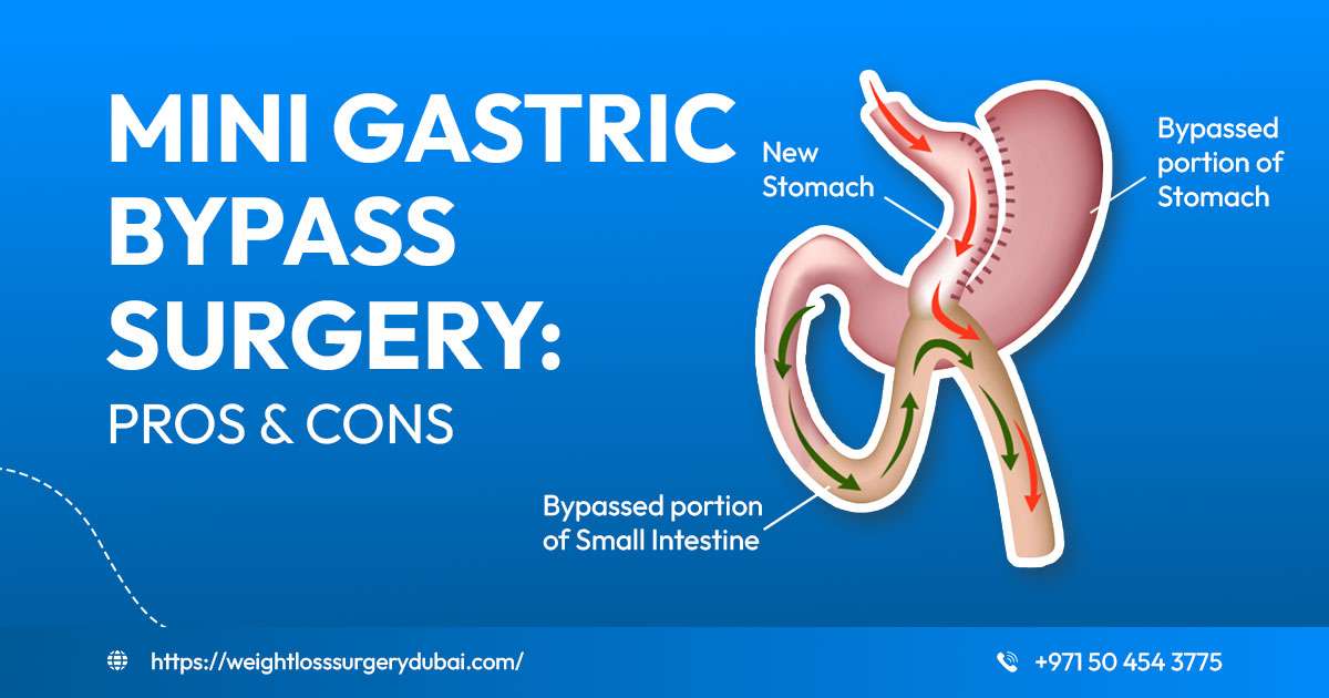 Mini Gastric Bypass Surgery Pros and Cons