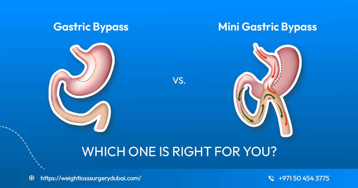 Mini Gastric Bypass vs. Gastric Bypass in Dubai Clinics