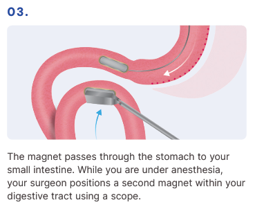 MagDI System - How it works 03
