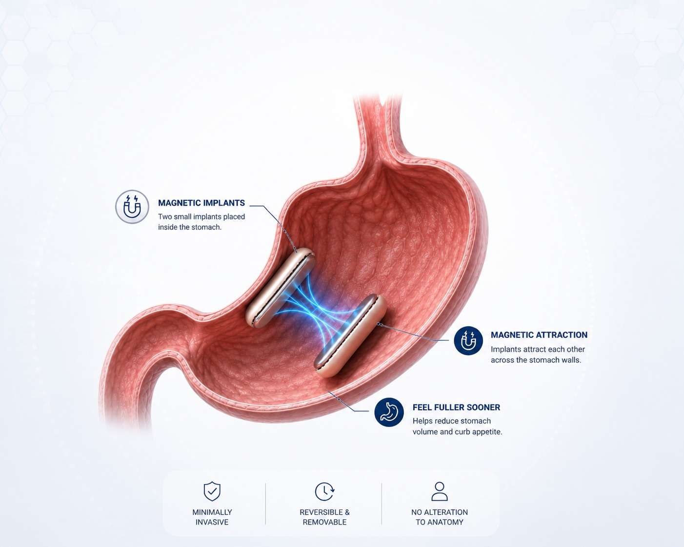 MagDI magnetic weight loss surgery illustration