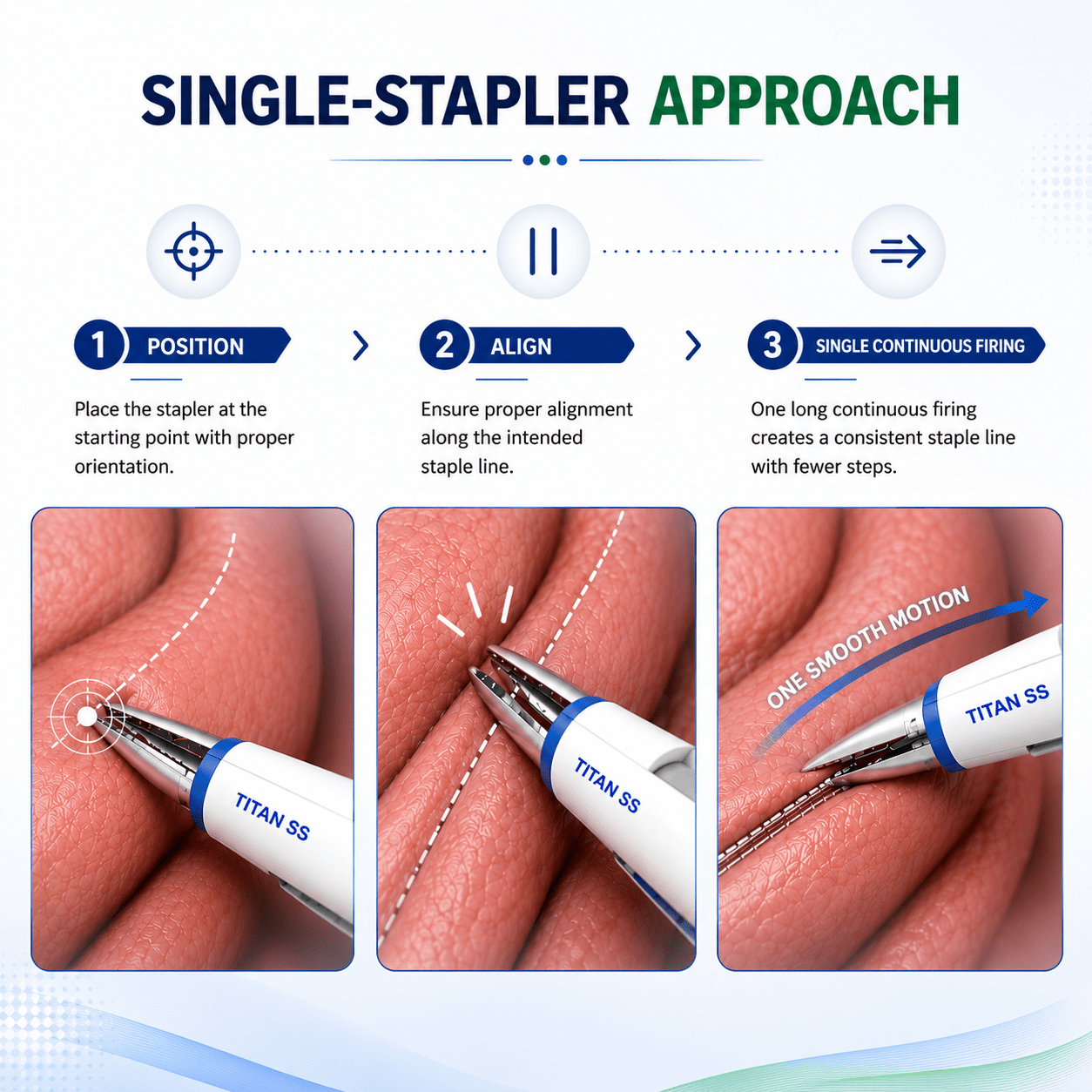 Single-stapler approach showing the three steps of positioning, alignment, and single continuous firing to create a consistent staple line with fewer stapling steps during surgery.