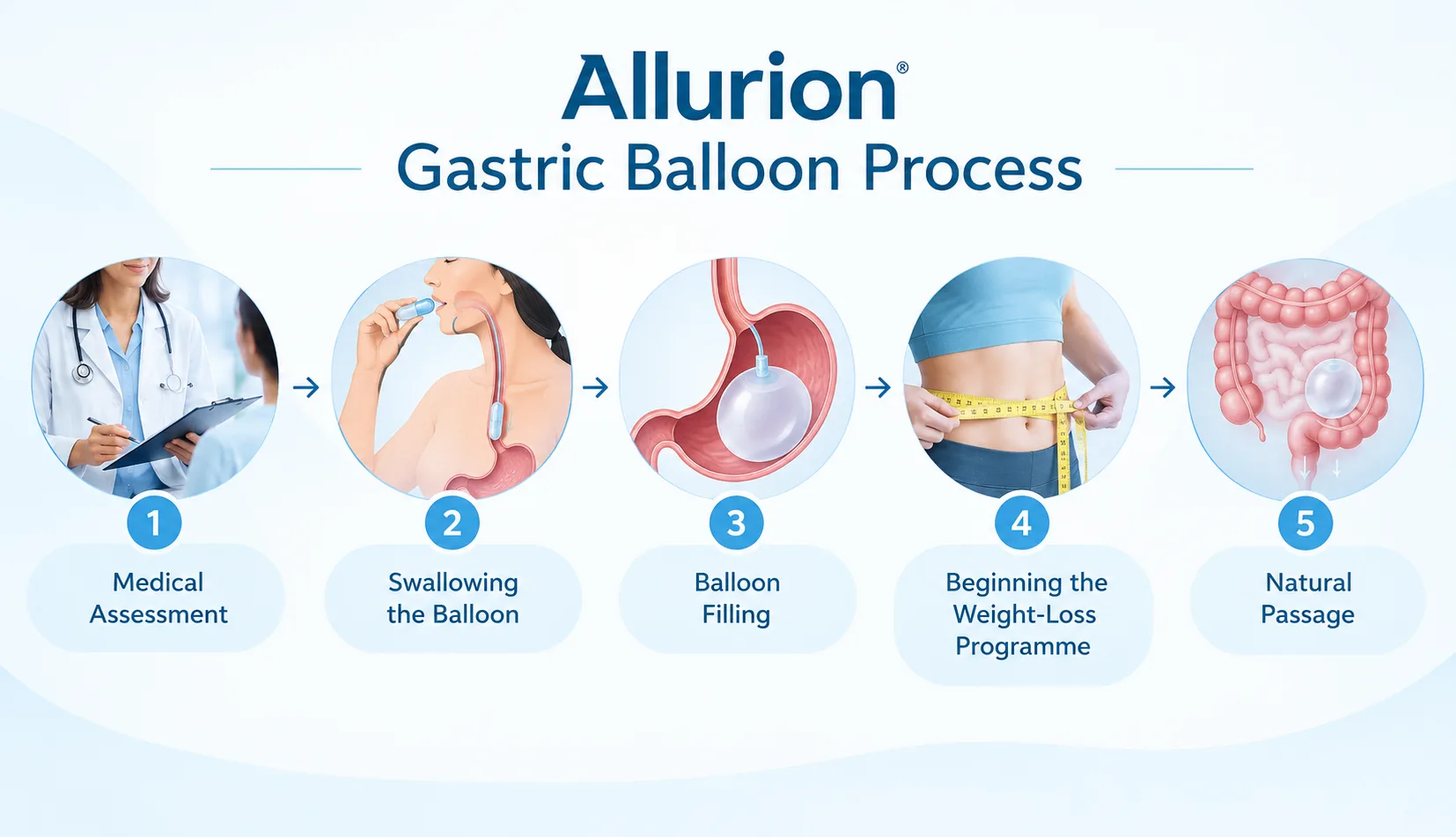 Illustration of the Allurion Gastric Balloon process, including assessment, swallowing, filling, weight-loss programme and natural passage, by Dr. Girish Juneja.