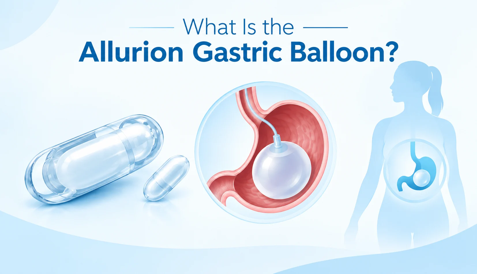What Is the Allurion Gastric Balloon? Medical illustration showing the swallowable balloon capsule and inflated gastric balloon inside the stomach, by Dr. Girish Juneja.