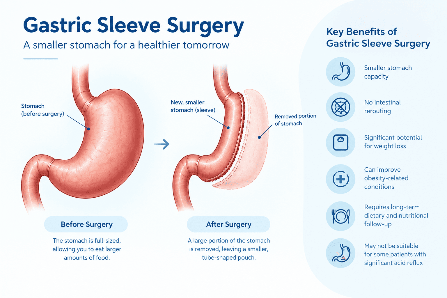 Gastric sleeve surgery before and after showing reduced stomach size