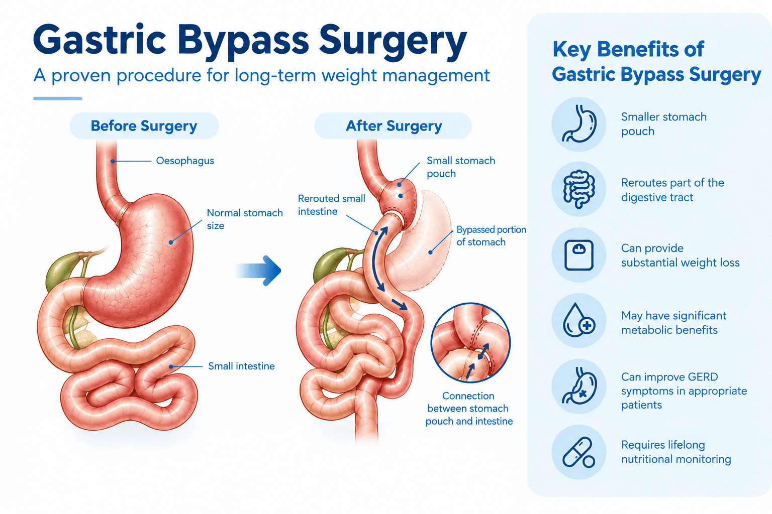 Gastric bypass surgery showing small stomach pouch and rerouted intestine
