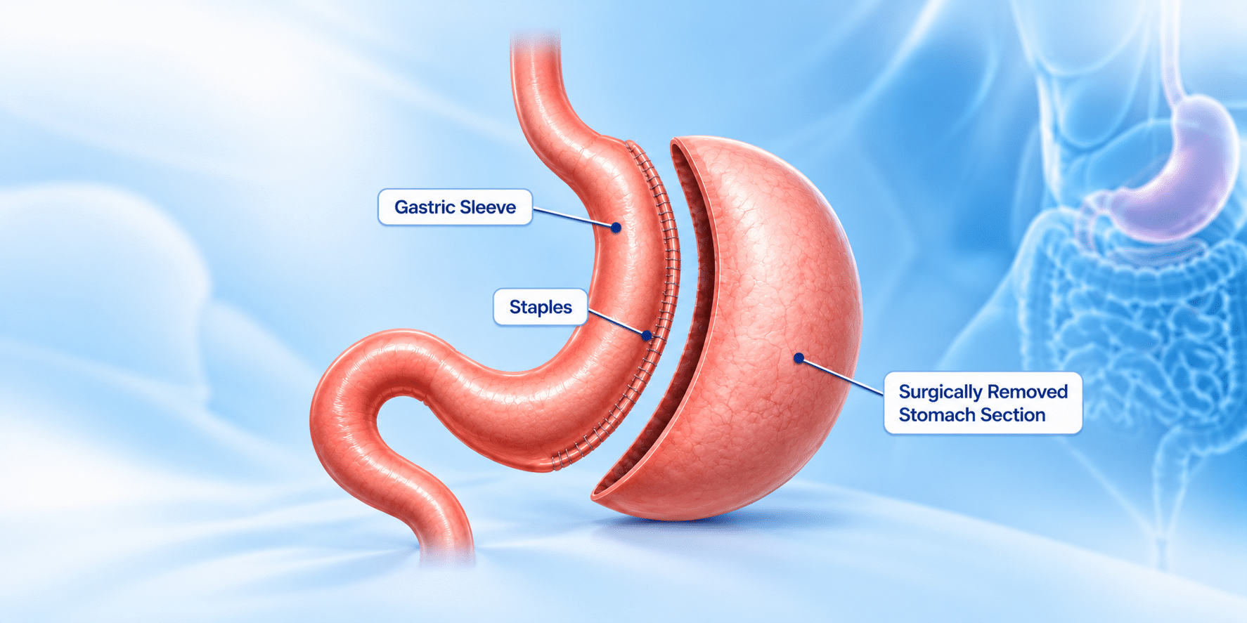 Gastric sleeve surgery procedure illustration showing sleeve gastrectomy and the surgically removed portion of the stomach.