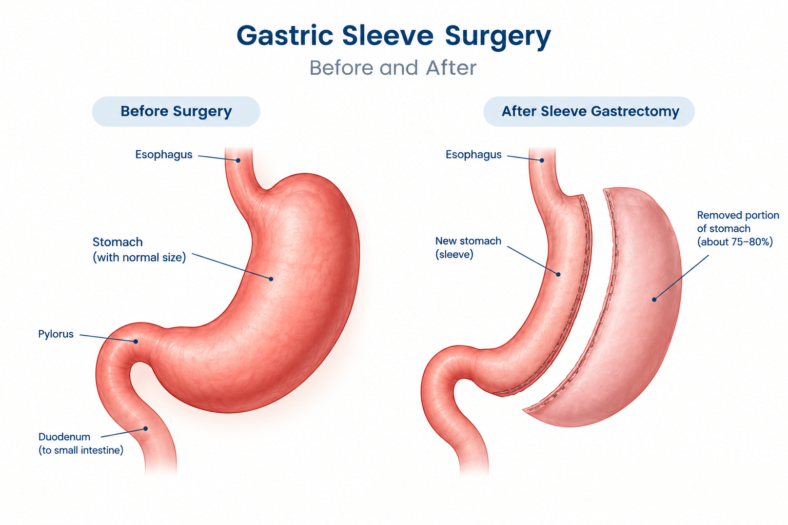 Gastric sleeve surgery before and after illustration showing the reduced stomach and staple line.