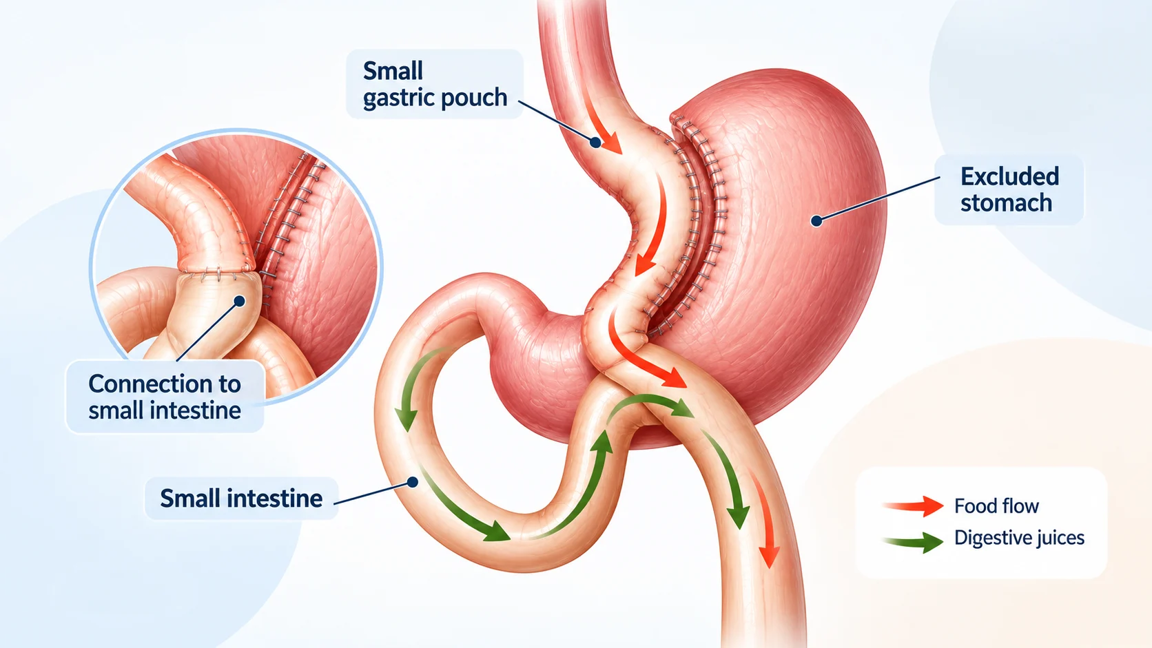 Medical illustration of mini gastric bypass surgery showing the small gastric pouch, excluded stomach, small intestine connection, and food and digestive juice flow.