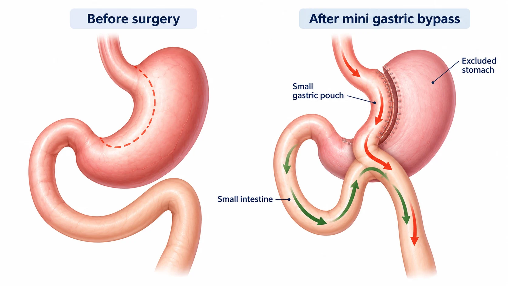 Medical illustration of mini gastric bypass surgery before and after, showing the small gastric pouch, excluded stomach, small intestine and food flow.