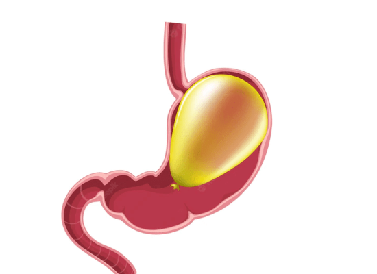 Intragastric Balloon